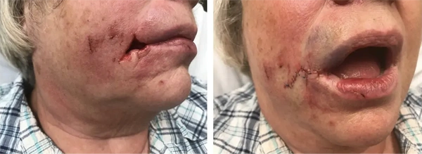 Real patient results before and after plastic surgery results in Long Island, NY, performed by Dr. Sotirios Papafragkou.