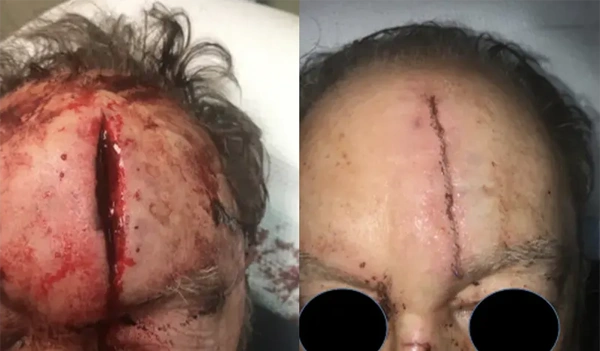 Real patient results before and after plastic surgery results in Long Island, NY, performed by Dr. Sotirios Papafragkou.