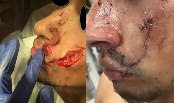 Real patient results before and after plastic surgery results in Long Island, NY, performed by Dr. Sotirios Papafragkou.