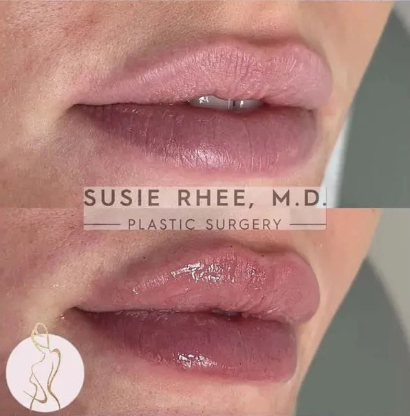 Real patient results before and after plastic surgery results in Long Island, NY, performed by Dr. Sotirios Papafragkou.