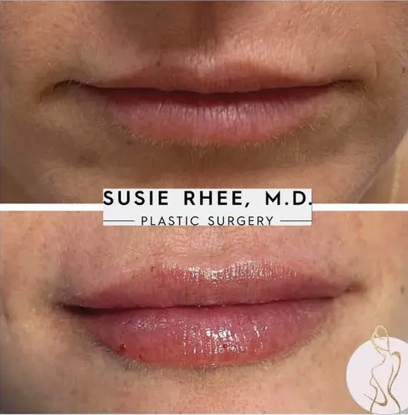Real patient results before and after plastic surgery results in Long Island, NY, performed by Dr. Sotirios Papafragkou.