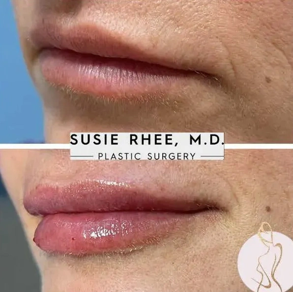Real patient results before and after plastic surgery results in Long Island, NY, performed by Dr. Sotirios Papafragkou.