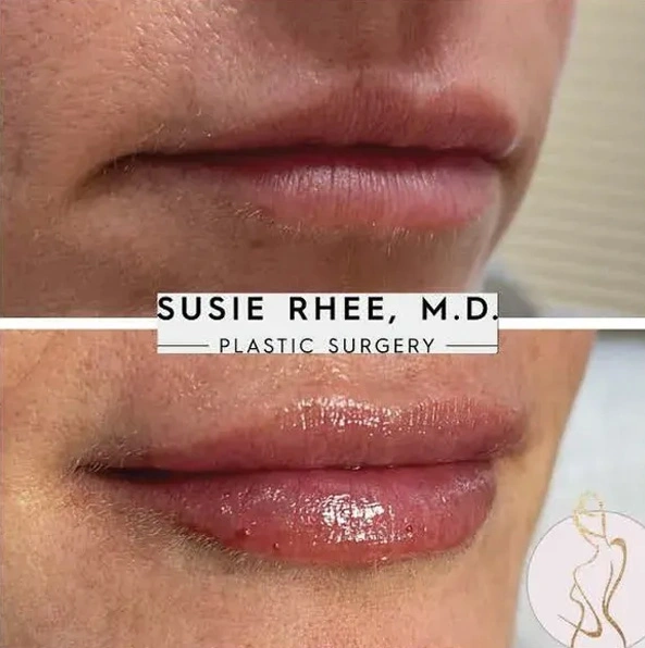 Real patient results before and after plastic surgery results in Long Island, NY, performed by Dr. Sotirios Papafragkou.