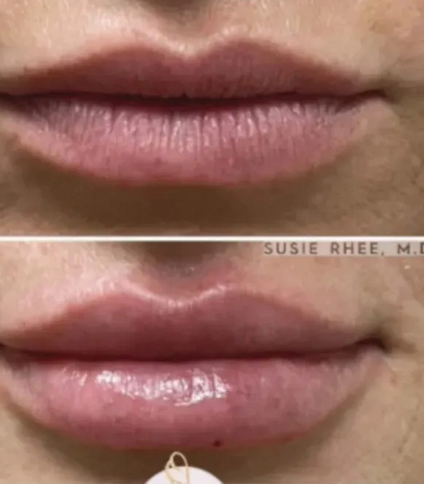 Real patient results before and after plastic surgery results in Long Island, NY, performed by Dr. Sotirios Papafragkou.