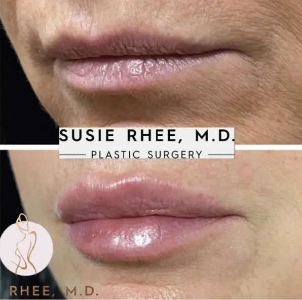 Real patient results before and after plastic surgery results in Long Island, NY, performed by Dr. Sotirios Papafragkou.