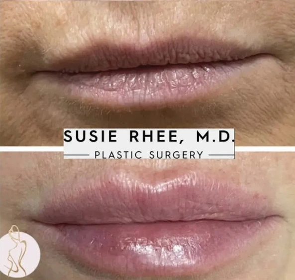 Real patient results before and after plastic surgery results in Long Island, NY, performed by Dr. Sotirios Papafragkou.