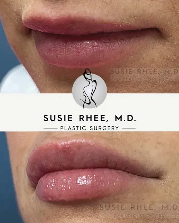 Real patient results before and after plastic surgery results in Long Island, NY, performed by Dr. Sotirios Papafragkou.