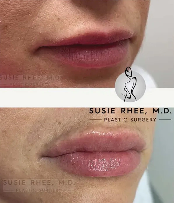Real patient results before and after plastic surgery results in Long Island, NY, performed by Dr. Sotirios Papafragkou.