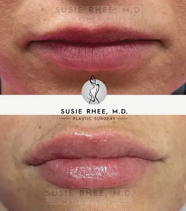 Real patient results before and after plastic surgery results in Long Island, NY, performed by Dr. Sotirios Papafragkou.