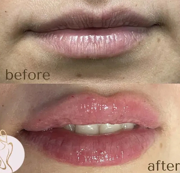 Real patient results before and after plastic surgery results in Long Island, NY, performed by Dr. Sotirios Papafragkou.