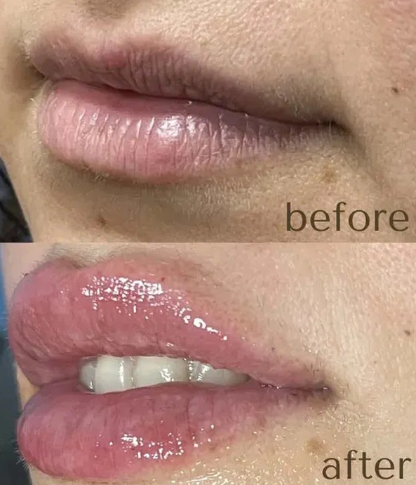Real patient results before and after plastic surgery results in Long Island, NY, performed by Dr. Sotirios Papafragkou.