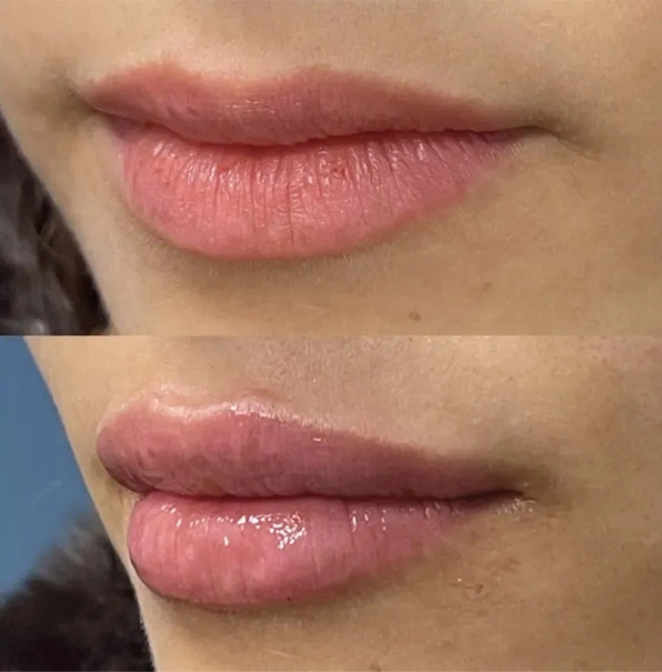 Real patient results before and after plastic surgery results in Long Island, NY, performed by Dr. Sotirios Papafragkou.