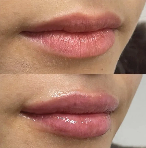 Real patient results before and after plastic surgery results in Long Island, NY, performed by Dr. Sotirios Papafragkou.