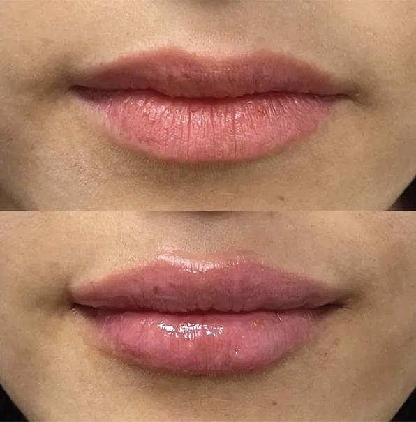 Real patient results before and after plastic surgery results in Long Island, NY, performed by Dr. Sotirios Papafragkou.