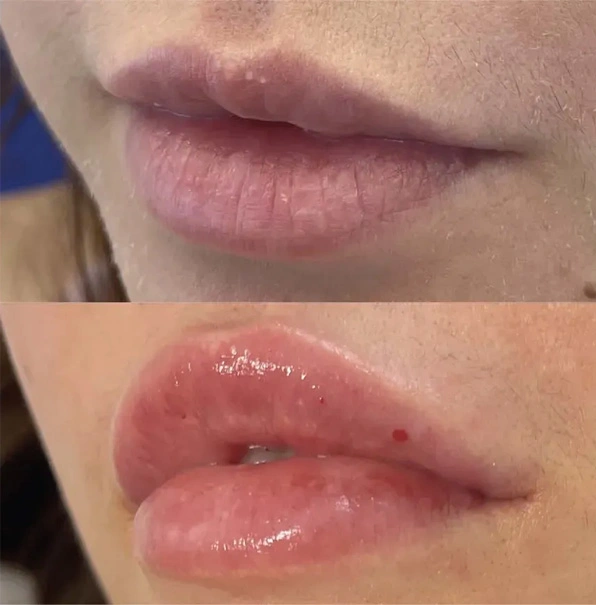 Real patient results before and after plastic surgery results in Long Island, NY, performed by Dr. Sotirios Papafragkou.