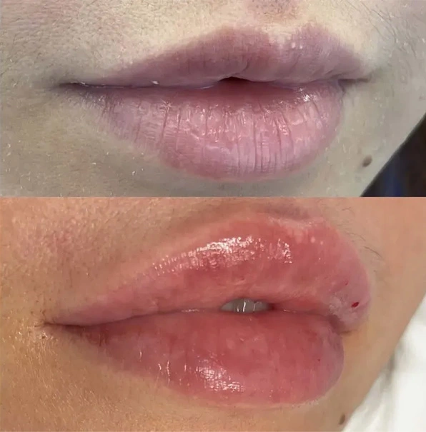 Real patient results before and after plastic surgery results in Long Island, NY, performed by Dr. Sotirios Papafragkou.