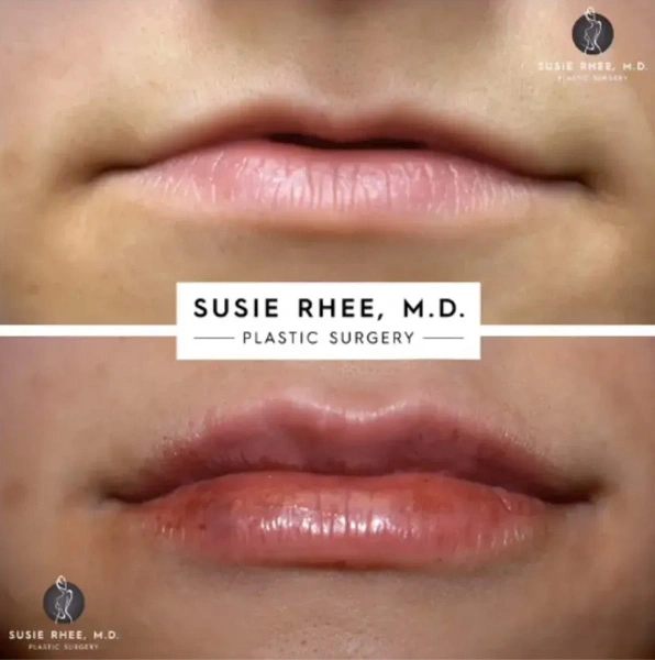 Real patient results before and after plastic surgery results in Long Island, NY, performed by Dr. Sotirios Papafragkou.