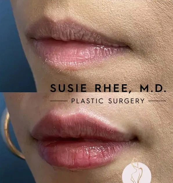 Real patient results before and after plastic surgery results in Long Island, NY, performed by Dr. Sotirios Papafragkou.