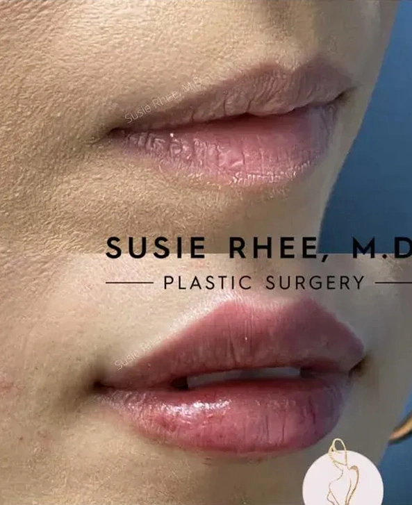 Real patient results before and after plastic surgery results in Long Island, NY, performed by Dr. Sotirios Papafragkou.