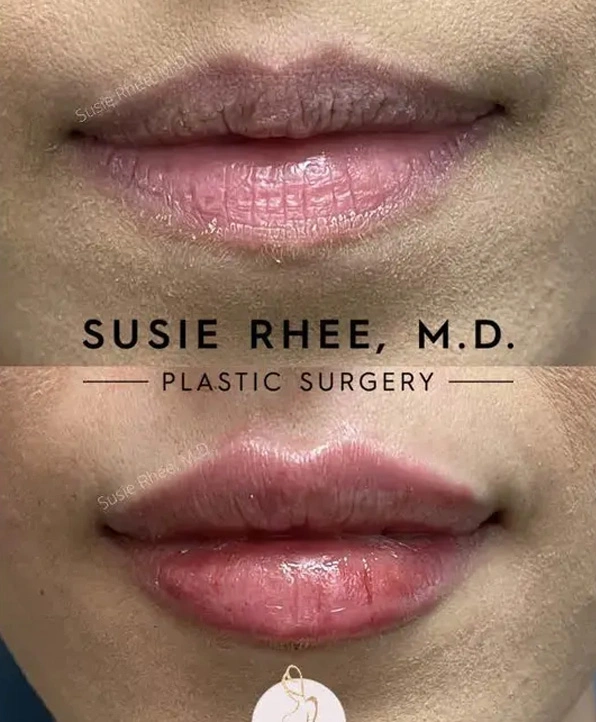Real patient results before and after plastic surgery results in Long Island, NY, performed by Dr. Sotirios Papafragkou.