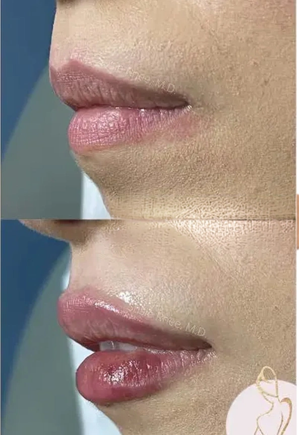 Real patient results before and after plastic surgery results in Long Island, NY, performed by Dr. Sotirios Papafragkou.