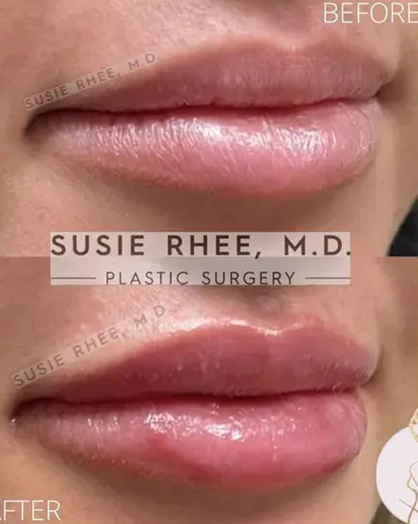 Real patient results before and after plastic surgery results in Long Island, NY, performed by Dr. Sotirios Papafragkou.