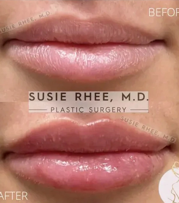 Real patient results before and after plastic surgery results in Long Island, NY, performed by Dr. Sotirios Papafragkou.
