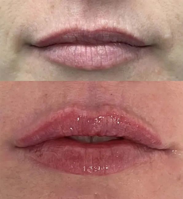 Real patient results before and after plastic surgery results in Long Island, NY, performed by Dr. Sotirios Papafragkou.