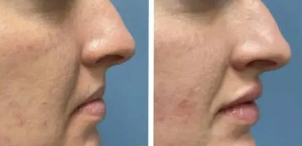 Real patient results before and after plastic surgery results in Long Island, NY, performed by Dr. Sotirios Papafragkou.