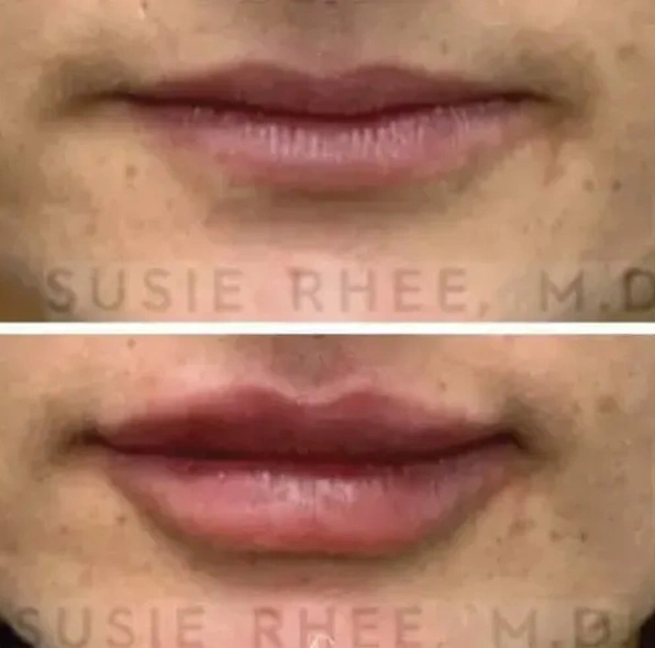 Real patient results before and after plastic surgery results in Long Island, NY, performed by Dr. Sotirios Papafragkou.
