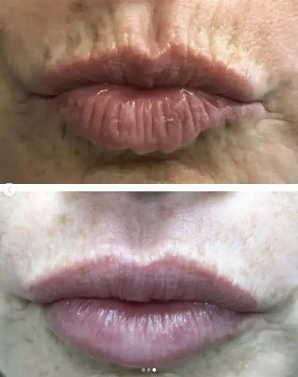 Real patient results before and after plastic surgery results in Long Island, NY, performed by Dr. Sotirios Papafragkou.
