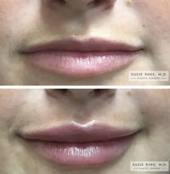 Real patient results before and after plastic surgery results in Long Island, NY, performed by Dr. Sotirios Papafragkou.