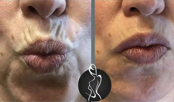 Real patient results before and after plastic surgery results in Long Island, NY, performed by Dr. Sotirios Papafragkou.
