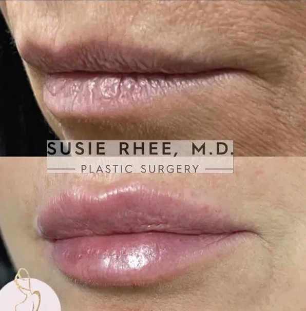 Real patient results before and after plastic surgery results in Long Island, NY, performed by Dr. Sotirios Papafragkou.