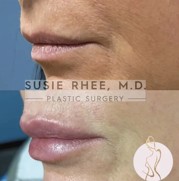 Real patient results before and after plastic surgery results in Long Island, NY, performed by Dr. Sotirios Papafragkou.