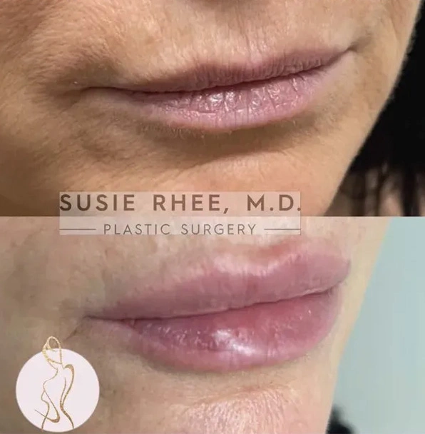 Real patient results before and after plastic surgery results in Long Island, NY, performed by Dr. Sotirios Papafragkou.