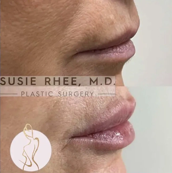 Real patient results before and after plastic surgery results in Long Island, NY, performed by Dr. Sotirios Papafragkou.