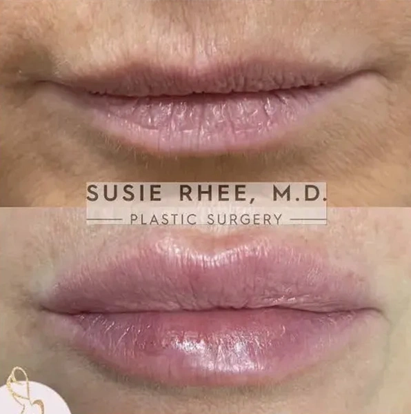 Real patient results before and after plastic surgery results in Long Island, NY, performed by Dr. Sotirios Papafragkou.