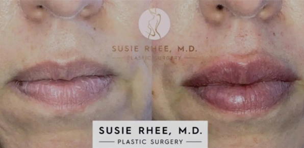 Real patient results before and after plastic surgery results in Long Island, NY, performed by Dr. Sotirios Papafragkou.