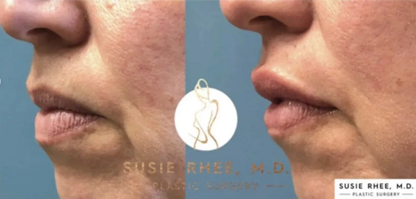 Real patient results before and after plastic surgery results in Long Island, NY, performed by Dr. Sotirios Papafragkou.