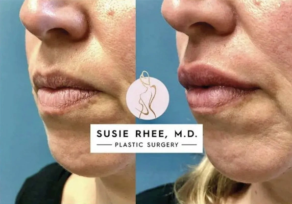 Real patient results before and after plastic surgery results in Long Island, NY, performed by Dr. Sotirios Papafragkou.