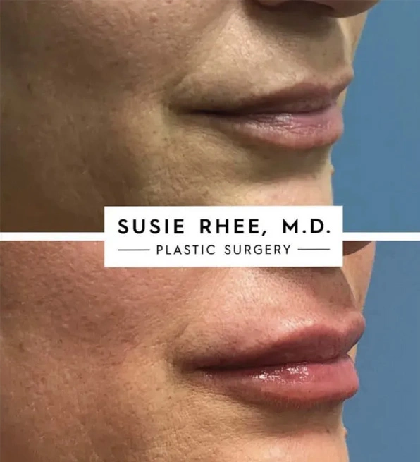 Real patient results before and after plastic surgery results in Long Island, NY, performed by Dr. Sotirios Papafragkou.