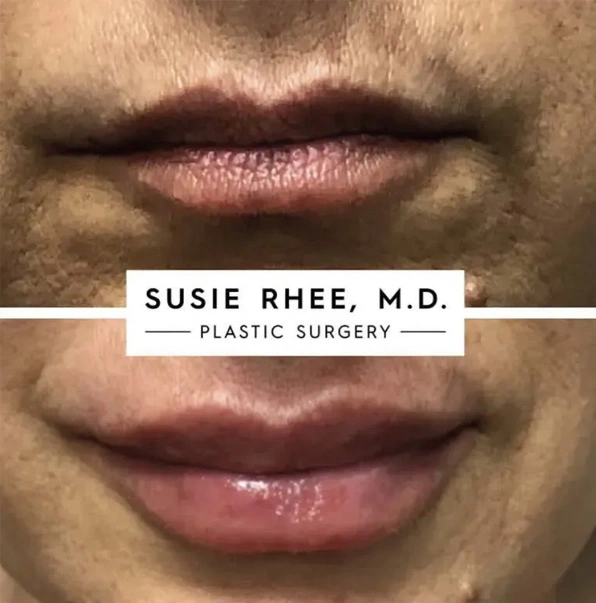 Real patient results before and after plastic surgery results in Long Island, NY, performed by Dr. Sotirios Papafragkou.