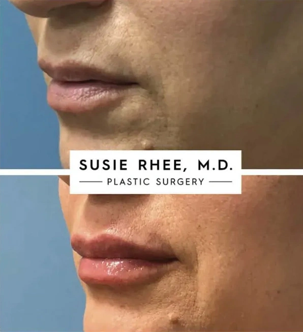 Real patient results before and after plastic surgery results in Long Island, NY, performed by Dr. Sotirios Papafragkou.