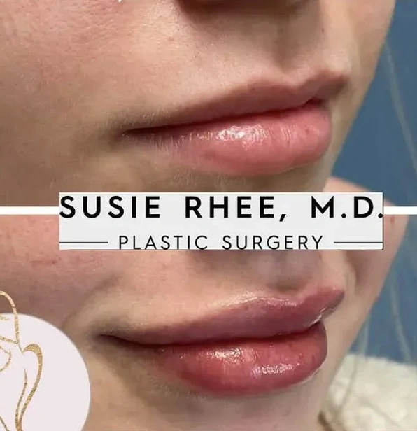 Real patient results before and after plastic surgery results in Long Island, NY, performed by Dr. Sotirios Papafragkou.