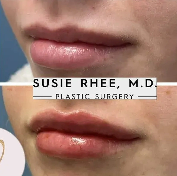 Real patient results before and after plastic surgery results in Long Island, NY, performed by Dr. Sotirios Papafragkou.