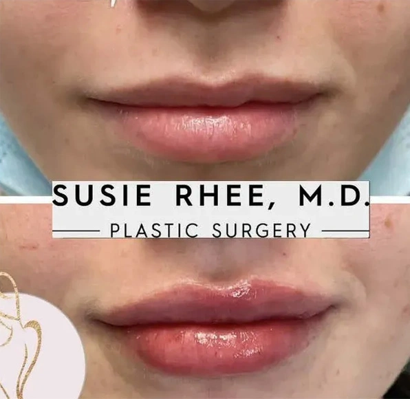 Real patient results before and after plastic surgery results in Long Island, NY, performed by Dr. Sotirios Papafragkou.