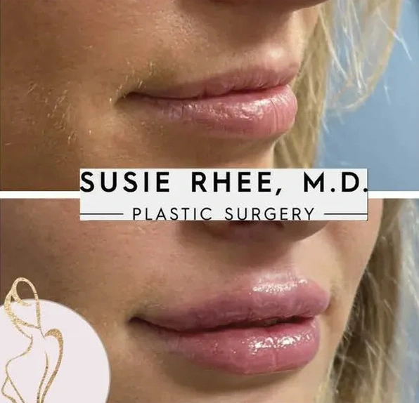 Real patient results before and after plastic surgery results in Long Island, NY, performed by Dr. Sotirios Papafragkou.