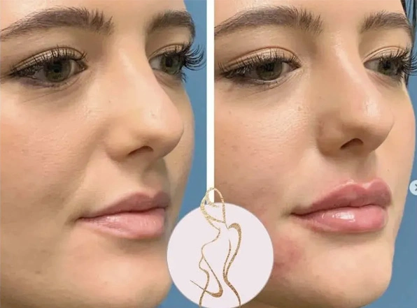 Real patient results before and after plastic surgery results in Long Island, NY, performed by Dr. Sotirios Papafragkou.