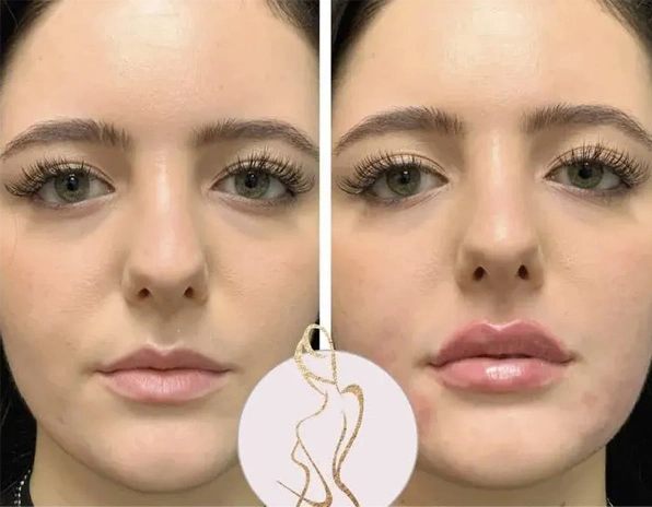 Real patient results before and after plastic surgery results in Long Island, NY, performed by Dr. Sotirios Papafragkou.